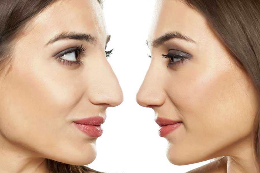 Коррекция формы носа: как превратить недостаток в достоинство