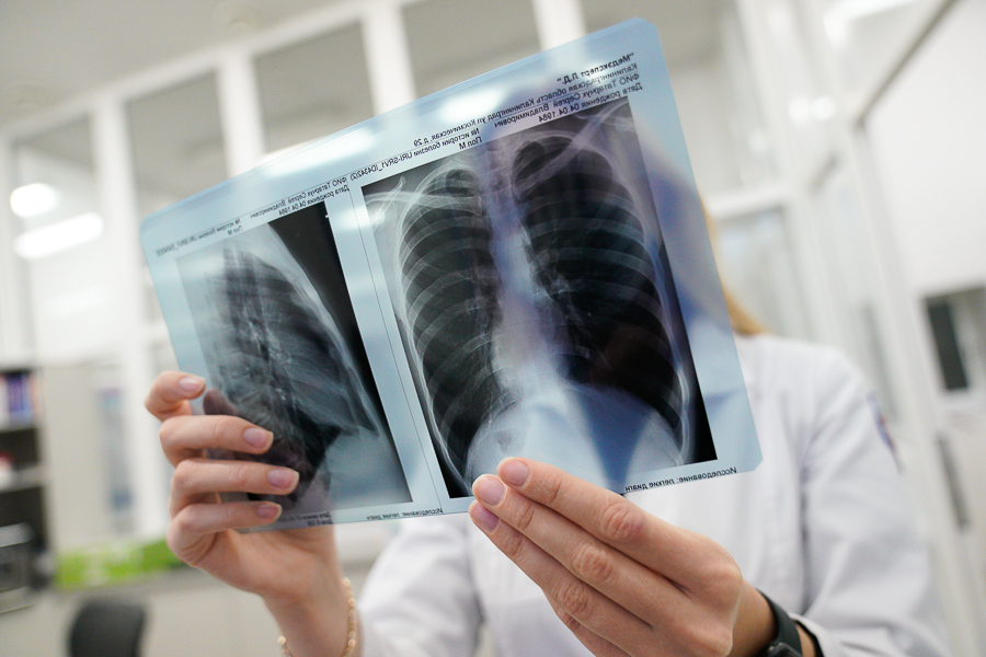 В Роспотребнадзоре рассказали, сколько калининградцев заразились туберкулезом в 2022 году