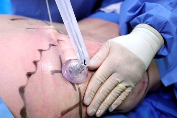 VIP Clinic: липосакция без реабилитации и тройной эффект за одну процедуру