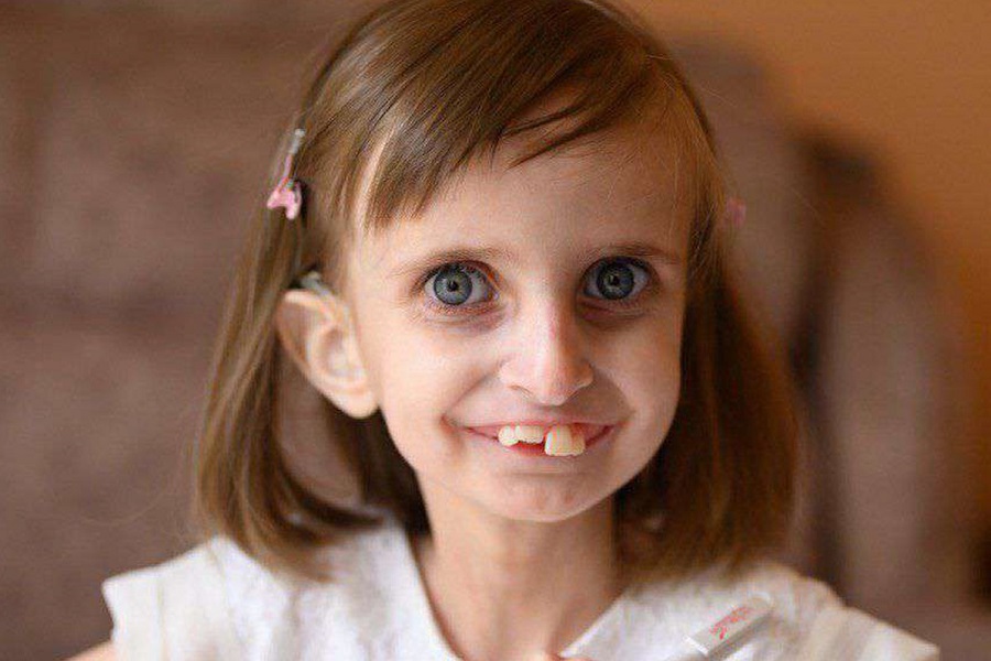 Объявлен сбор средств для 10-летней светловчанки с редкой генетической мутацией