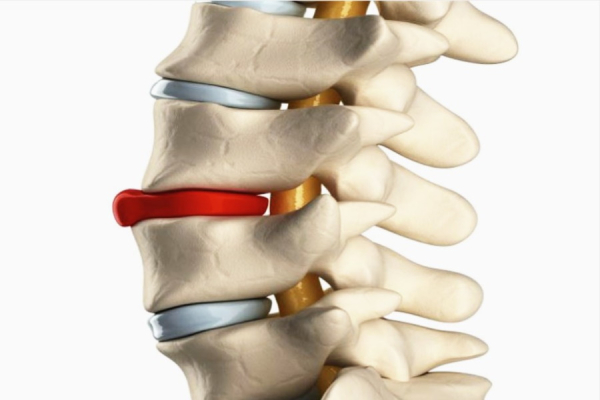 Грыжи или протрузии в позвоночнике: где пройти реабилитацию без операции