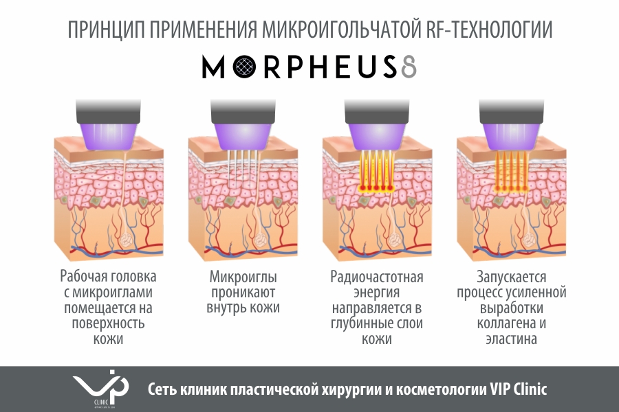 Лифтинг morpheus отзывы. Игольчатый RF-лифтинг Morpheus 8. Фракционный микроигольчатый RF лифтинг лица. Микроигольчатый фракционный RF - лифтинг (morpheus8).